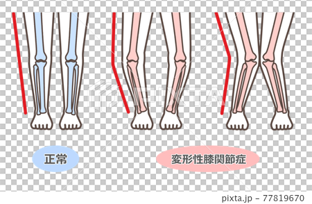 変形性膝関節症　図解 77819670