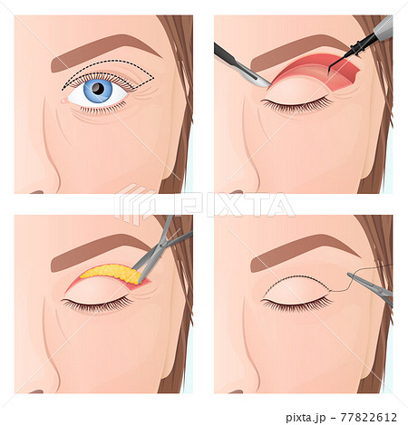 upper eyelid plastic surgery procedure, step by step process 77822612