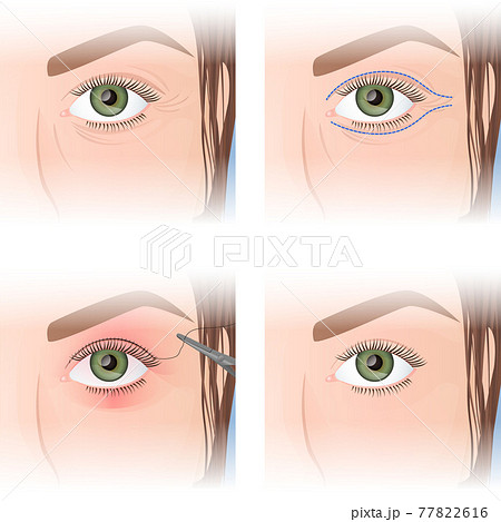 blepharoplasty, upper eyelid plastic, before and after images 77822616