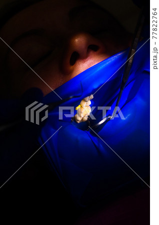 Close-up of the patient's mouth after filling the teeth with white composite resin on the insulation of a rubber dam, rubber dam and dental mirror. Close-up of the patient's mouth after filling the teeth with white composite resin on the insulation of a rubber dam, rubber dam and dental mirror. 77822764