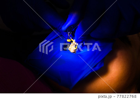 Installation of a rubber dam by a dentist, sterile and modern dental treatment. 77822768