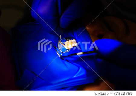 Dental procedure, treatment of the upper masticatory tooth, modern dental treatment with a rubber dam. 77822769