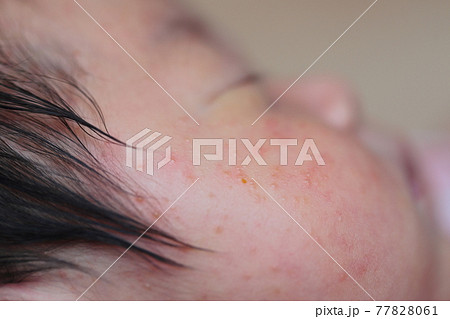 新生児の乳児湿疹 77828061