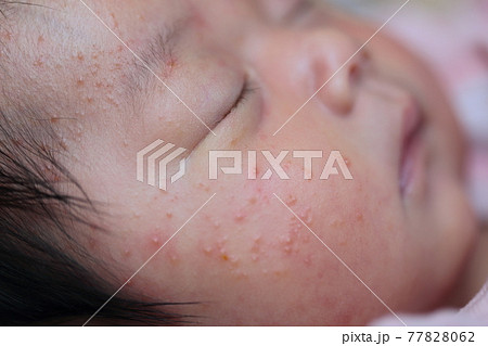 新生児の乳児湿疹の写真素材