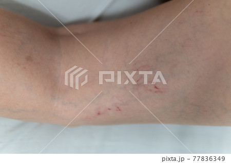 removal of blood vessels by laser vessel venous disease, varicose problem patient close vein, cutout risk enlarged, aesthetic telangiectases physical 77836349