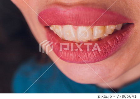 Brasket system in a girl's smiling mouth, macro photography of teeth. large face and painted lips. Braces on the teeth of a girl who smiles. 77865641