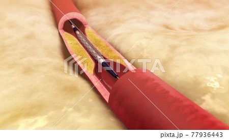 Clogged Artery with platelets and cholesterol plaque, medical illustration 77936443