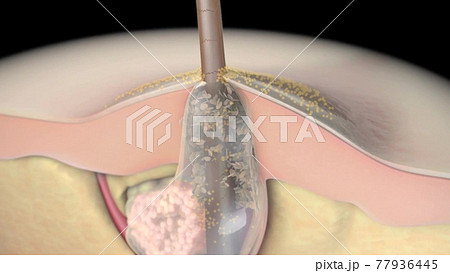 Acne And Pimples, Stages Of Development, Graphic Animation 77936445