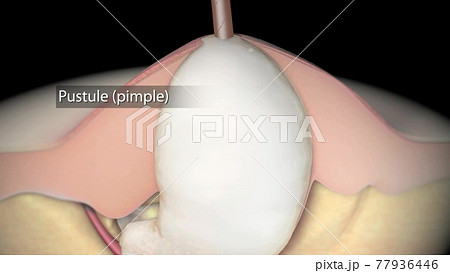 Acne And Pimples, Stages Of Development, Graphic Animation 77936446