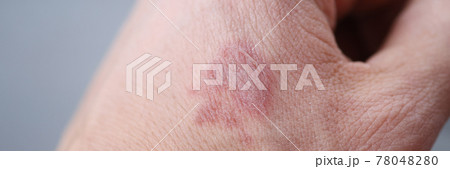 Closeup of burn stain on mans hand 78048280
