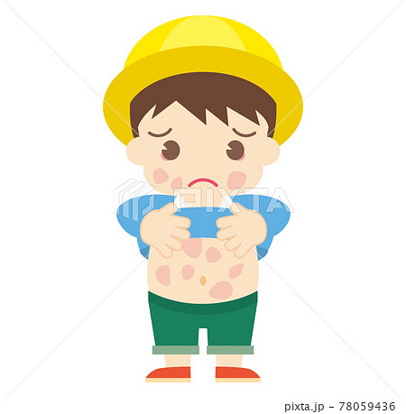 じんましんが出てしまった男の子（帽子あり） 78059436