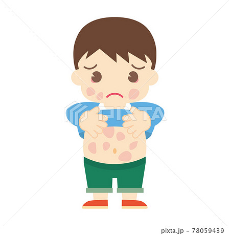 じんましんが出てしまった男の子(帽子なし) じんましんが出てしまった男の子(帽子なし) 78059439