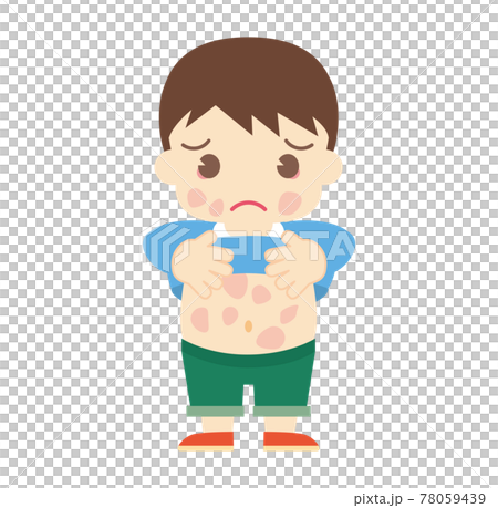 じんましんが出てしまった男の子(帽子なし) じんましんが出てしまった男の子(帽子なし) 78059439