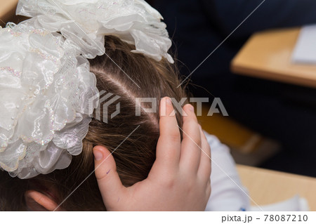 The girl's hand supporting her head and white fluffy bows on her head. The girl's hand supporting her head and white fluffy bows on her head. 78087210