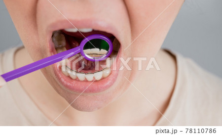 Close-up portrait of a woman with internal braces and a dental mirror. The girl corrects the bite Close-up portrait of a woman with internal braces and a dental mirror. The girl corrects the bite 78110786