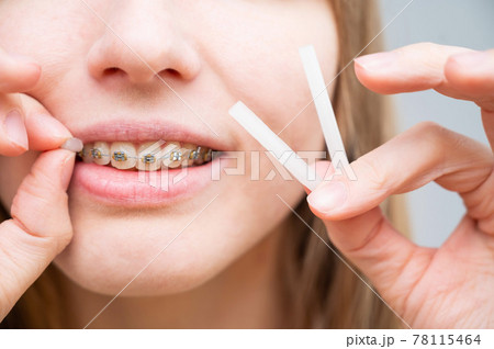Close-up portrait of a young woman applying orthodontic anti-scratch wax to the braces Close-up portrait of a young woman applying orthodontic anti-scratch wax to the braces 78115464