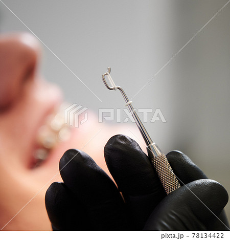White rubber band for braces on steel dental tool, macro snapshot White rubber band for braces on steel dental tool, macro snapshot 78134422