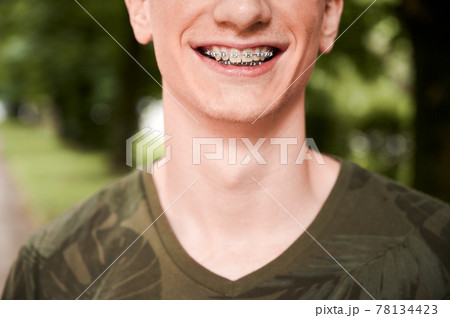 Cheerful young man showing teeth with braces. Cheerful young man showing teeth with braces. 78134423