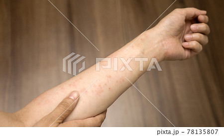 ストレスで腕に湿疹が出る女性の写真素材 [78135807] - PIXTA