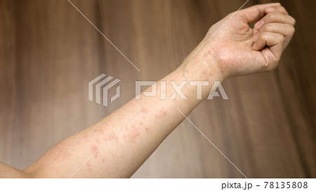 ストレスで腕に湿疹が出る女性の写真素材 [78135808] - PIXTA