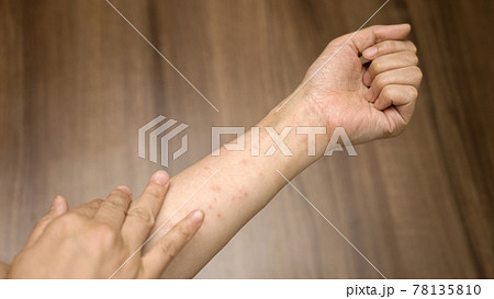 ストレスで腕に湿疹が出る女性の写真素材
