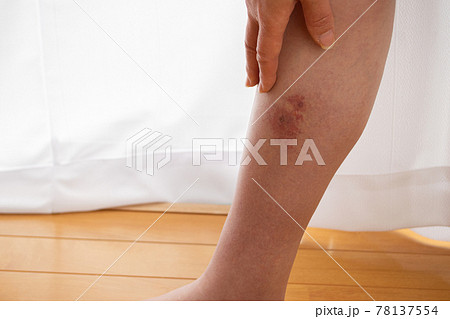 蜂窩織炎（蜂巣炎）の症状が出ている足のふくらはぎ内側 78137554