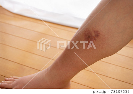 蜂窩織炎（蜂巣炎）の症状が出ている足のふくらはぎ内側 78137555