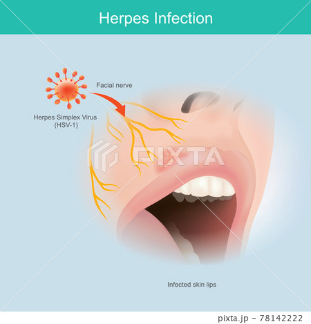 Herpes Infection. Illustration human facial nerve skin for use explain herpes simplex virus lip infection.. 78142222