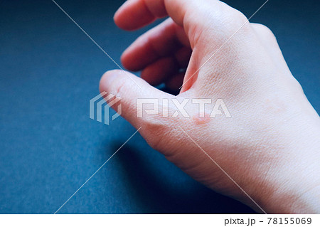 皮膚炎 肌トラブル 肌荒れ 湿疹 虫刺され 手湿疹 主婦湿疹 家事湿疹 5 皮膚炎 肌トラブル 肌荒れ 湿疹 虫刺され 手湿疹 主婦湿疹 家事湿疹 5 78155069