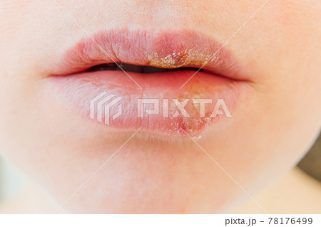 Close up of girl lips affected by herpes. Treatment of herpes infection and virus. Part of young woman face, lips with herpes affected. Beauty dermatology concept. Close up of girl lips affected by herpes. Treatment of herpes infection and virus. Part of young woman face, lips with herpes affected. Beauty dermatology concept. 78176499
