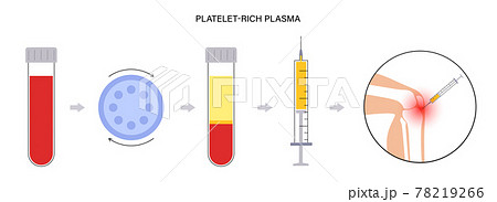 Platelet rich plasma concept Platelet rich plasma concept 78219266