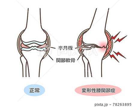 変形性膝関節症のイラスト 変形性膝関節症のイラスト 78263895