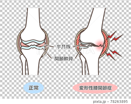 変形性膝関節症のイラスト 変形性膝関節症のイラスト 78263895