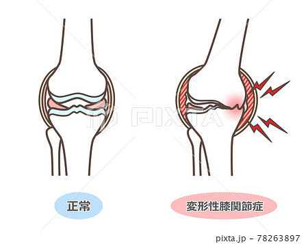 変形性膝関節症のイラストのイラスト素材 7637