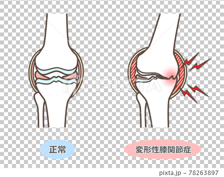 Illustration of knee osteoarthritis 78263897