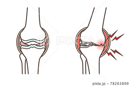 変形性膝関節症のイラスト 78263899
