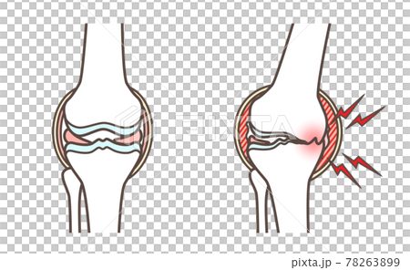 Illustration of knee osteoarthritis 78263899