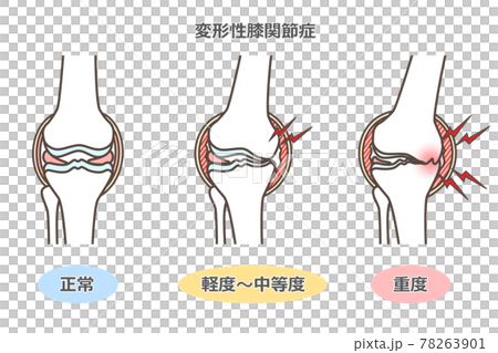 変形性膝関節症のイラスト 78263901