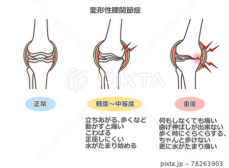 変形性膝関節症のイラストのイラスト素材