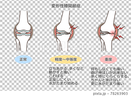 Illustration of knee osteoarthritis 78263903