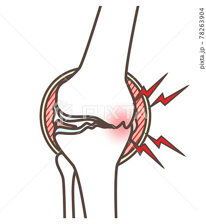 変形性膝関節症のイラストのイラスト素材