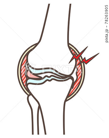 変形性膝関節症のイラスト 78263905