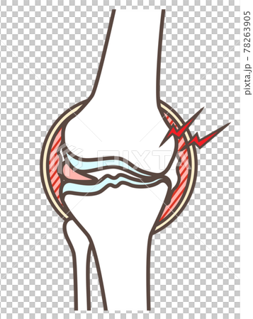 変形性膝関節症のイラスト 78263905