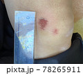 怪我した 78265911