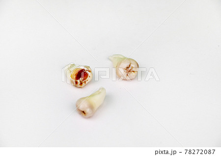 Removed wisdom tooth on white Removed wisdom tooth on white 78272087