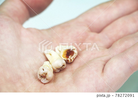 Removed wisdom tooth on white 78272091