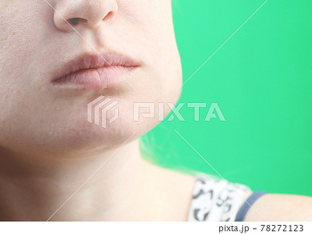 Teeth Problem. Gumboil, flux and swelling of the cheek. Closeup Of Beautiful Sad Girl Suffering From Strong Tooth Pain. Attractive Female Feeling Painful Toothache, Dental Health And Care Concept 78272123