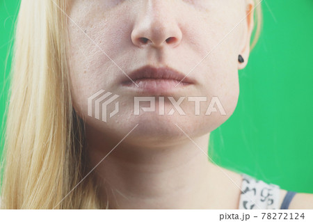 Teeth Problem. Gumboil, flux and swelling of the cheek. Closeup Of Beautiful Sad Girl Suffering From Strong Tooth Pain. Attractive Female Feeling Painful Toothache, Dental Health And Care Concept 78272124