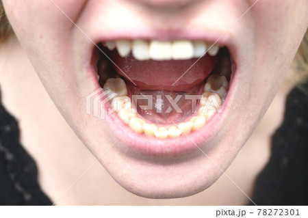 Plaque of the patient, stone. Dentistry treatment of dental plaque, professional oral hygiene, The concept of harm to smoking and cleaningteeth Plaque of the patient, stone. Dentistry treatment of dental plaque, professional oral hygiene, The concept of harm to smoking and cleaningteeth 78272301