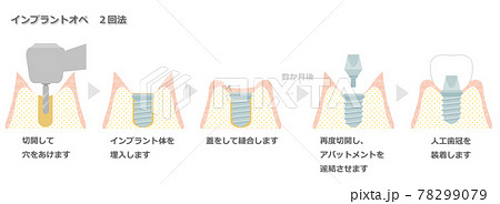 インプラントオペ_2回法 インプラントオペ_2回法 78299079